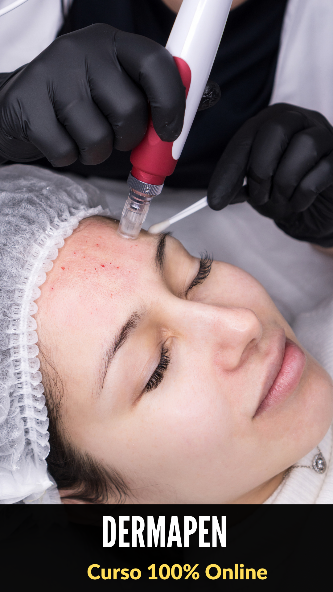 Dermapen Microneedling con Yess Lacroix
